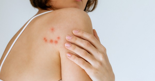 Как обнаружить постельных клопов Как обнаружить постельных клопов